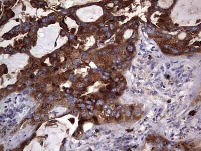 Immunohistochemistry: CD63 Antibody (OTI5E5) - Azide and BSA Free [NBP2-70380] - Analysis of Carcinoma of Human lung tissue.(Heat-induced epitope retrieval by 1 mM EDTA in 10mM Tris, pH8.5, 120C for 3min)