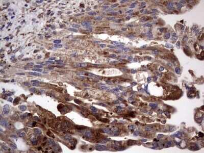 Immunohistochemistry: CD63 Antibody (OTI5E5) - Azide and BSA Free [NBP2-70380] - Analysis of Carcinoma of Human pancreas tissue. (Heat-induced epitope retrieval by 1 mM EDTA in 10mM Tris, pH8.5, 120C for 3min)