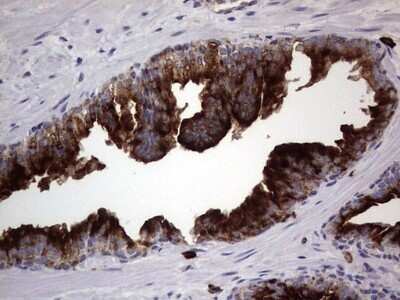 Immunohistochemistry: CD63 Antibody (OTI5E5) - Azide and BSA Free [NBP2-70380] - Analysis of Carcinoma of Human prostate tissue. (Heat-induced epitope retrieval by 1 mM EDTA in 10mM Tris, pH8.5, 120C for 3min)