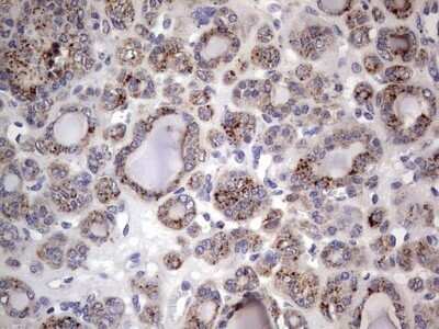 Immunohistochemistry: CD63 Antibody (OTI5E5) - Azide and BSA Free [NBP2-70380] - Analysis of Carcinoma of Human thyroid tissue. (Heat-induced epitope retrieval by 1 mM EDTA in 10mM Tris, pH8.5, 120C for 3min)