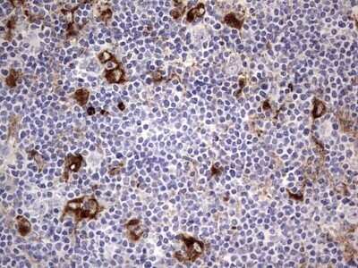 Immunohistochemistry: CD63 Antibody (OTI5E5) - Azide and BSA Free [NBP2-70380] - Analysis of Human lymphoma tissue. (Heat-induced epitope retrieval by 1 mM EDTA in 10mM Tris, pH8.5, 120C for 3min)