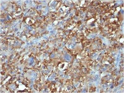 Immunohistochemistry-Paraffin: CD68/SR-D1 Antibody (C68/684) - IHC-Prediluted [NBP2-44541] - Formalin-fixed, paraffin-embedded human Histiocytoma stained with CD68/SR-D1 Antibody (C68/684).