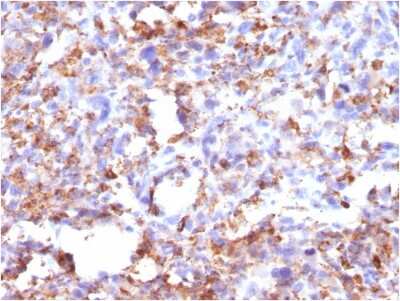 Immunohistochemistry-Paraffin: CD68/SR-D1 Antibody (CD68/G2) [NBP2-44544] - Formalin-fixed, paraffin-embedded human Histiocytoma stained with CD68/SR-D1 Antibody (CD68/G2).