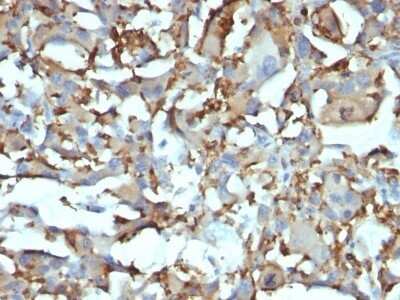 Immunohistochemistry-Paraffin: CD68/SR-D1 Antibody (KP1 + C68/684) - IHC-Prediluted [NBP2-44542] - Formalin-fixed, paraffin-embedded human Histiocytoma stained with CD68/SR-D1 Antibody (KP1 + C68/684).