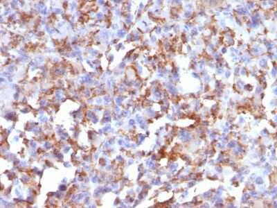 Immunohistochemistry-Paraffin: CD68/SR-D1 Antibody (LAMP4/824) - Azide and BSA Free [NBP2-47902] - Formalin-fixed, paraffin-embedded human Histiocytoma stained with CD68/SR-D1 Antibody (LAMP4/824).