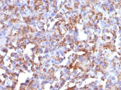 Immunohistochemistry-Paraffin: CD68/SR-D1 Antibody (LAMP4/824) - IHC-Prediluted [NBP2-48024] - Formalin-fixed, paraffin-embedded human Histiocytoma stained with CD68/SR-D1 Antibody (LAMP4/824).