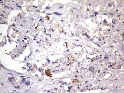 Immunohistochemistry: CD68/SR-D1 Antibody (OTI1E6) - Azide and BSA Free [NBP2-70381] - Analysis of Adenocarcinoma of Human colon tissue.