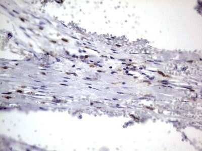 Immunohistochemistry: CD68/SR-D1 Antibody (OTI1E6) - Azide and BSA Free [NBP2-70381] - Analysis of Carcinoma of Human kidney tissue.