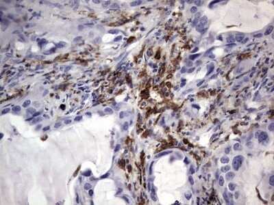 Immunohistochemistry: CD68/SR-D1 Antibody (OTI1E6) - Azide and BSA Free [NBP2-70381] - Analysis of Carcinoma of Human lung tissue.