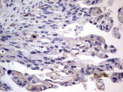 Immunohistochemistry: CD68/SR-D1 Antibody (OTI1E6) - Azide and BSA Free [NBP2-70381] - Analysis of Carcinoma of Human pancreas tissue.