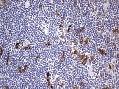 Immunohistochemistry: CD68/SR-D1 Antibody (OTI1E6) - Azide and BSA Free [NBP2-70381] - Analysis of Human lymphoma tissue.