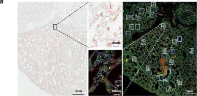 Immunohistochemistry: CD68/SR-D1 Antibody (SPM130) - Azide and BSA Free [NBP2-34736] - Intrapulmonary heterogeneity of SARS-CoV-2 host response. Selection of ROIs. Left) SARS-CoV-2 RNA-ISH staining was used to guide ROI selection of viral positive and viral negative regions. (Scale bar = 2 mm). Right) multi-color immunofluorescence staining for CD45/red (NBP2-34527AF647), CD68/yellow (NBP2-34736AF594), PanCK/green, and DNA/blue were used in parallel to select ROIs. (Scale bar = 2 mm). Example ROIs are shown in insets. (Scale bar = 100 um). Image collected and cropped by CiteAb from the following publication (//pubmed.ncbi.nlm.nih.gov/33298930/) licensed under a CC-BY license.