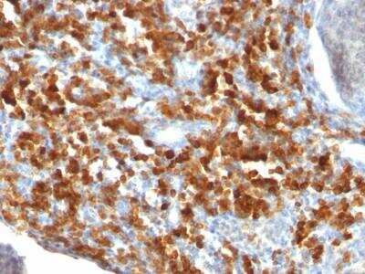Immunohistochemistry-Paraffin: CD79A Antibody (IGA/515) - IHC-Prediluted [NBP2-48030] - Formalin-fixed, paraffin-embedded human Lymphoma stained with CD79a Monoclonal Antibody (IGA/515).