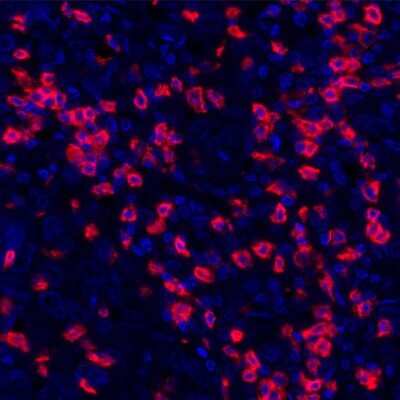 Immunocytochemistry/Immunofluorescence: CD8 Antibody (BLR044F) [NBP2-76422] - Detection of human CD8 alpha (red) in FFPE breast carcinoma by IHC-IF.  Antibody: Rabbit anti-CD8 alpha recombinant monoclonal [BLR044F]. Secondary: HRP-conjugated goat anti-rabbit IgG. Substrate: Opal™. Counterstain: DAPI (blue).