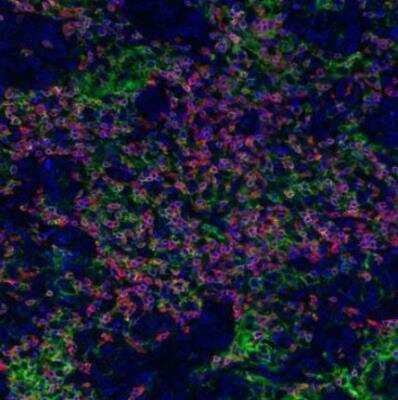 Immunocytochemistry/Immunofluorescence: CD8 Antibody (BLR044F) [NBP2-76422] - Multiplex immunofluorescence analysis using rabbit anti-CD3E recombinant monoclonal [BL-298-5D12] , rabbit anti-CD8 alpha recombinant monoclonal [BLR044F], rabbit anti-PD-L1 recombinant monoclonal [BLR020E]. Secondary: HRP-conjugated goat anti-rabbit IgG.  Substrate: Opal™ 520, 620, and 690. Counterstain: DAPI (blue).