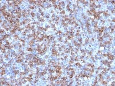 Immunohistochemistry-Paraffin: CD8 Antibody (C8/1779R) [NBP2-53189] - Formalin-fixed, paraffin-embedded human Lymphoma stained with CD8 Antibody (C8/1779R).