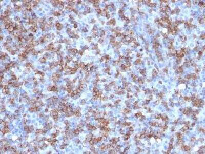 Immunohistochemistry-Paraffin: CD8 Antibody (C8/1779R) - Azide and BSA Free [NBP2-54595] - CD8 alpha Antibody (C8/1779R) [NBP2-54595] - Formalin-fixed, paraffin-embedded human Lymphoma stained with CD8 Antibody (C8/1779R).