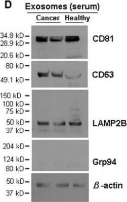 Western Blot: CD81 Antibody (1D6) - Azide and BSA Free [NBP2-80660] - Isolation and characterization of exosomes from cell culture supernatant and human blood. Immunoblot of exosomal markers CD81 (~30 kDa), CD63 (~55 kDa), and LAMP2B (~50 kDa) in exosomes (5 ug lysates) isolated from the serum of breast cancer patients and healthy control. Grp94 (~100 kDa) and beta-actin (~42 kDa) serve as a negative control and a loading control, respectively. Image collected and cropped by CiteAb from the following publication (//www.nature.com/articles/srep36502), licensed under a CC-BY license. Image from the standard format of this antibody.