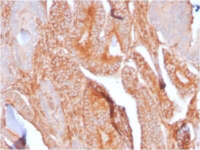 Immunohistochemistry-Paraffin: CD81 Antibody (C81/2885R) - Azide and BSA Free [NBP3-08796] - Formalin-fixed, paraffin-embedded human Prostate Carcinoma stained with CD81 Rabbit Recombinant Monoclonal Antibody (C81/2885R).