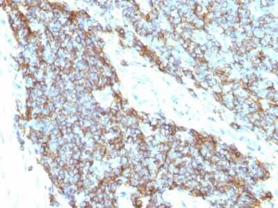 Immunohistochemistry-Paraffin: CD99 Antibody (12E7 + MIC2/877) - IHC-Prediluted [NBP2-48036] - Human Ewing's sarcoma stained with CD99 Monoclonal Antibody (12E7+MIC2/877).