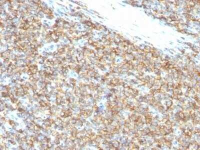 Immunohistochemistry-Paraffin: CD99 Antibody (12E7) - IHC-Prediluted [NBP2-48033] - Human Ewing's Sarcoma stained with CD99 Monoclonal Antibody (12E7).