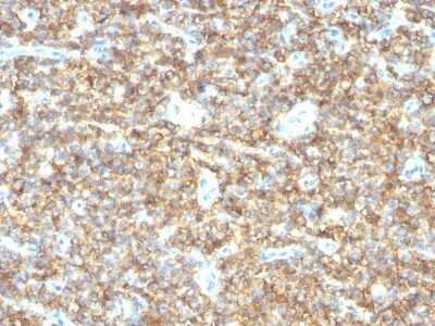 Immunohistochemistry-Paraffin: CD99 Antibody (HO36-1.1) - Azide and BSA Free [NBP2-47894] - Human Ewing's Sarcoma stained with CD99 Monoclonal Antibody (HO36-1.1).