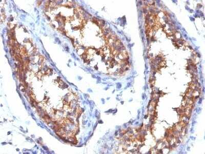 Immunohistochemistry-Paraffin: CD99 Antibody (HO36-1.1) - Azide and BSA Free [NBP2-47894] - Human Testicular Carcinoma stained with CD99 Monoclonal Antibody (HO36-1.1).