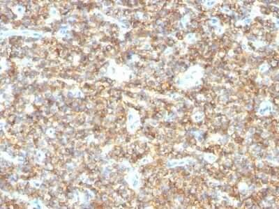 Immunohistochemistry-Paraffin: CD99 Antibody (HO36-1.1) - IHC-Prediluted [NBP2-48031] - Human Ewing's Sarcoma stained with CD99 Monoclonal Antibody (HO36-1.1).