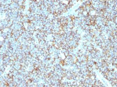 Immunohistochemistry-Paraffin: CD99 Antibody (MIC2/1495R) [NBP2-53368] - Formalin-fixed, paraffin-embedded human Ewing’s Sarcoma stained with CD99 Recombinant Rabbit Monoclonal Antibody (MIC2/1495R).