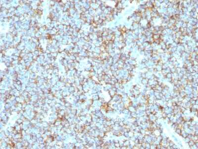 Immunohistochemistry-Paraffin: CD99 Antibody (MIC2/1495R) [NBP2-54373] - Formalin-fixed, paraffin-embedded human Ewing’s Sarcoma stained with CD99 Recombinant Rabbit Monoclonal Antibody (MIC2/1495R).