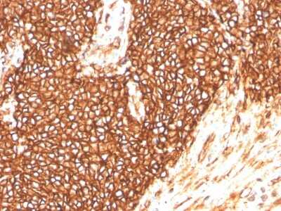Immunohistochemistry-Paraffin: CD99 Antibody (MIC2/3478R) - Azide and BSA Free [NBP3-08589] - Formalin-fixed, paraffin-embedded human Ewing's Sarcoma stained with CD99 Rabbit Recombinant Monoclonal Antibody (MIC2/3478R).