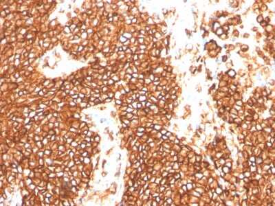 Immunohistochemistry-Paraffin: CD99 Antibody (MIC2/3478R) - Azide and BSA Free [NBP3-08589] - Formalin-fixed, paraffin-embedded human Ewing's Sarcoma stained with CD99 Rabbit Recombinant Monoclonal Antibody (MIC2/3478R).