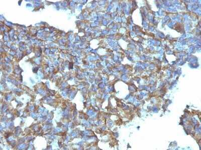 Immunohistochemistry-Paraffin: CD99 Antibody (MIC2/877) - Azide and BSA Free [NBP2-47895] - Human Ovarian Carcinoma & stained with CD99 Monoclonal Antibody (MIC2/877).