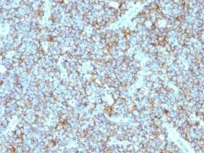 Immunohistochemistry-Paraffin: CD99 Antibody (MIC2/877) - Azide and BSA Free [NBP2-47895] - Human Ewing's Sarcoma stained with CD99 Monoclonal Antibody (MIC2/877).