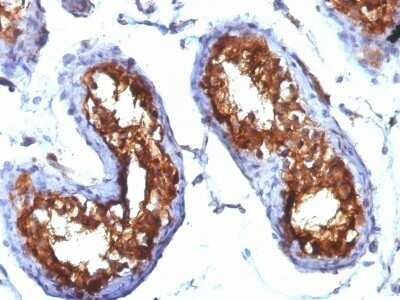 Immunohistochemistry-Paraffin: CD99 Antibody (MIC2/877) - IHC-Prediluted [NBP2-48034] - Human Testicular Carcinoma & stained with CD99 Monoclonal Antibody (MIC2/877).