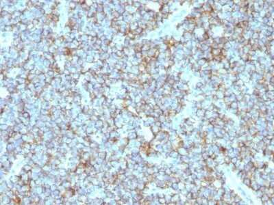 Immunohistochemistry-Paraffin: CD99 Antibody (MIC2/877) - IHC-Prediluted [NBP2-48034] - Human Ewing's Sarcoma stained with CD99 Monoclonal Antibody (MIC2/877).