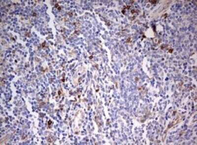 Immunohistochemistry: CD99 Antibody (OTI1D5) - Azide and BSA Free [NBP2-71197] - Analysis of Human lymphoma tissue. (Heat-induced epitope retrieval by 10mM citric buffer, pH6.0, 120C for 3min)