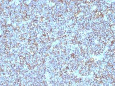 Immunohistochemistry-Paraffin: CD99 Antibody (SPM596) - IHC-Prediluted [NBP2-48035] - Human Ewing's Sarcoma stained with CD99 Monoclonal Antibody (SPM596).