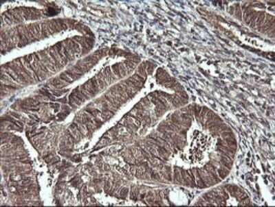 Immunohistochemistry: CDC123 Antibody (OTI1F8) - Azide and BSA Free [NBP2-71391] - Analysis of Adenocarcinoma of Human endometrium tissue. (Heat-induced epitope retrieval by 10mM citric buffer, pH6.0, 120C for 3min)