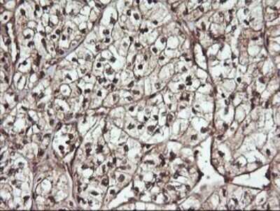 Immunohistochemistry: CDC123 Antibody (OTI1F8) - Azide and BSA Free [NBP2-71391] - Analysis of Carcinoma of Human kidney tissue. (Heat-induced epitope retrieval by 10mM citric buffer, pH6.0, 120C for 3min)