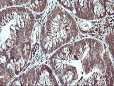 Immunohistochemistry: CDC123 Antibody (OTI1F8) [NBP2-45600] - Analysis of Adenocarcinoma of Human colon tissue. (Heat-induced epitope retrieval by 10mM citric buffer, pH6.0, 120C for 3min)