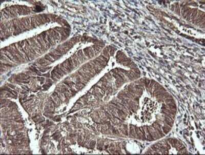 Immunohistochemistry: CDC123 Antibody (OTI1F8) [NBP2-45600] - Analysis of Adenocarcinoma of Human endometrium tissue. (Heat-induced epitope retrieval by 10mM citric buffer, pH6.0, 120C for 3min)