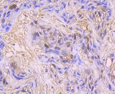 Immunohistochemistry-Paraffin: CDC2/CDK1 Antibody (SM01-44) [NBP2-66764] - Analysis of paraffin-embedded human breast carcinoma tissue using anti-CDK1 antibody. Counter stained with hematoxylin.