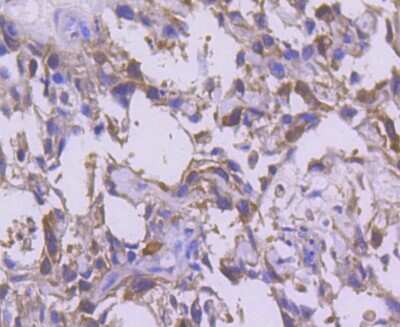 Immunohistochemistry-Paraffin: CDC2/CDK1 Antibody (SM01-44) [NBP2-67438] - Analysis of paraffin-embedded human breast carcinoma tissue using anti-CDK1 antibody. Counter stained with hematoxylin.