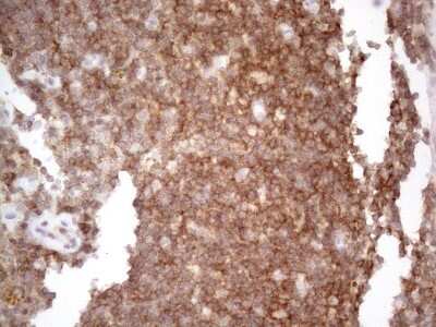 Immunohistochemistry: CDC42SE2 Antibody (1B12) [NBP2-46191] - Analysis of Carcinoma of Human thyroid tissue. (Heat-induced epitope retrieval by 1mM EDTA in 10mM Tris buffer (pH8.5) at 120C for 3 min)