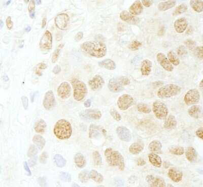 Immunohistochemistry: CDC5L Antibody [NB100-87014] - Sample: FFPE section of human breast carcinoma. Antibody: Affinity purified rabbit anti-CDC5L used at a dilution of 1:200 (1ug/ml). Detection: DAB staining using Immunohistochemistry Accessory Kit .