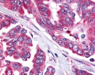 Immunohistochemistry-Paraffin: CDC7 Antibody [NLS7979] - Analysis of anti-CDC7 antibody with human ovary, carcinoma.