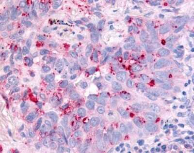 Immunohistochemistry-Paraffin: CDC7 Antibody [NLS7980] - Analysis of anti-CDC7 antibody with human lung, non-small cell carcinoma.