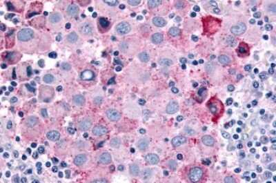 Immunohistochemistry-Paraffin: CDC7 Antibody [NLS7980] - Anti-CDC7 antibody IHC of human Skin, Melanoma. Immunohistochemistry of formalin-fixed, paraffin-embedded tissue after heat-induced antigen retrieval.