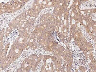 Immunohistochemistry-Paraffin: CDCA3 Antibody [NBP2-98988] - Immunochemical staining of human CDCA3 in human colon carcinoma with rabbit polyclonal antibody at 1:1000 dilution, formalin-fixed paraffin embedded sections.